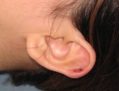 扎耳眼、割痦子需先查“瘢痕體質(zhì)”[tag]