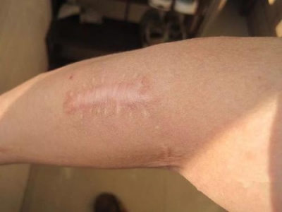 兒童外傷疤痕治療及護(hù)理[tag]