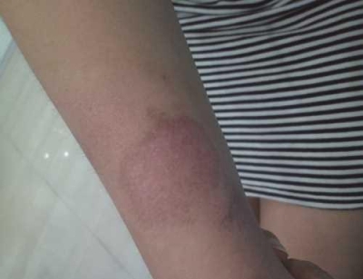 別讓小傷疤變成大疤痕[tag]