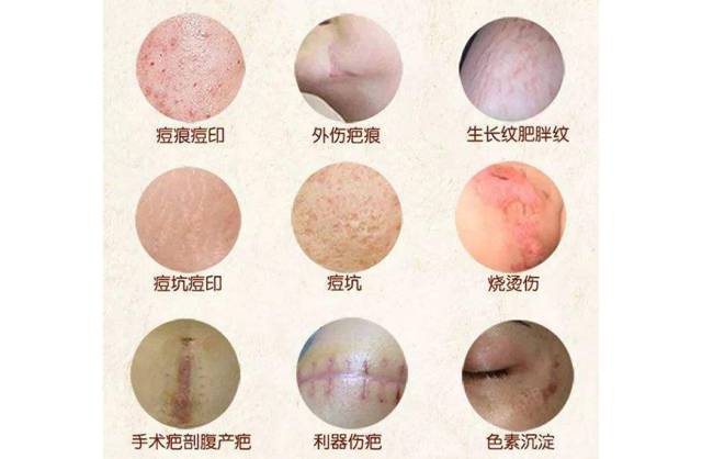 中醫(yī)治療疤痕疙瘩[tag]