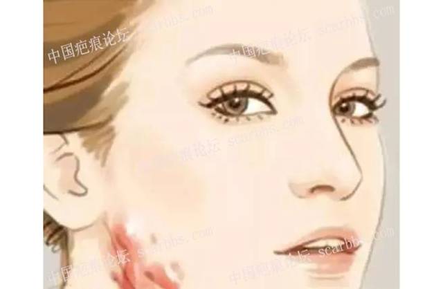 開水燙傷如何處理[tag]