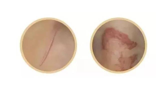 疤痕性色素沉著怎么治療？[tag]