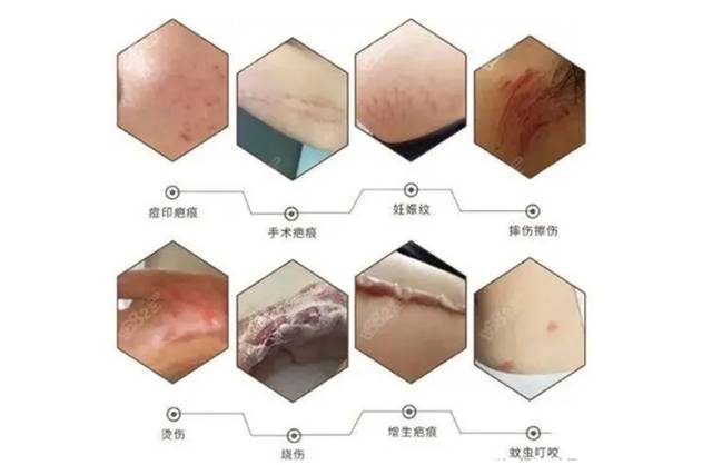怎么去除痘印痘疤[tag]